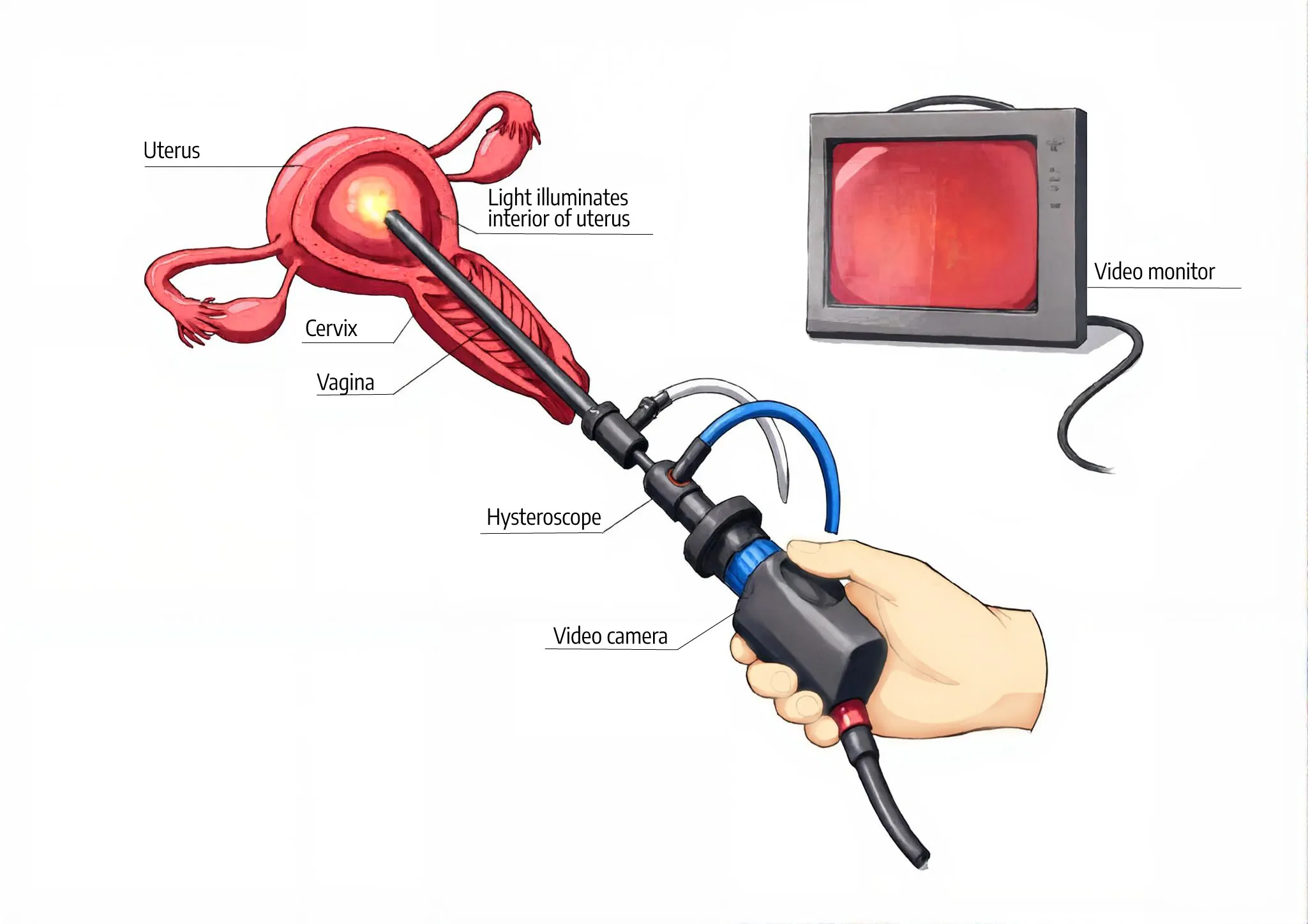Illustration of Office Hysteroscopy