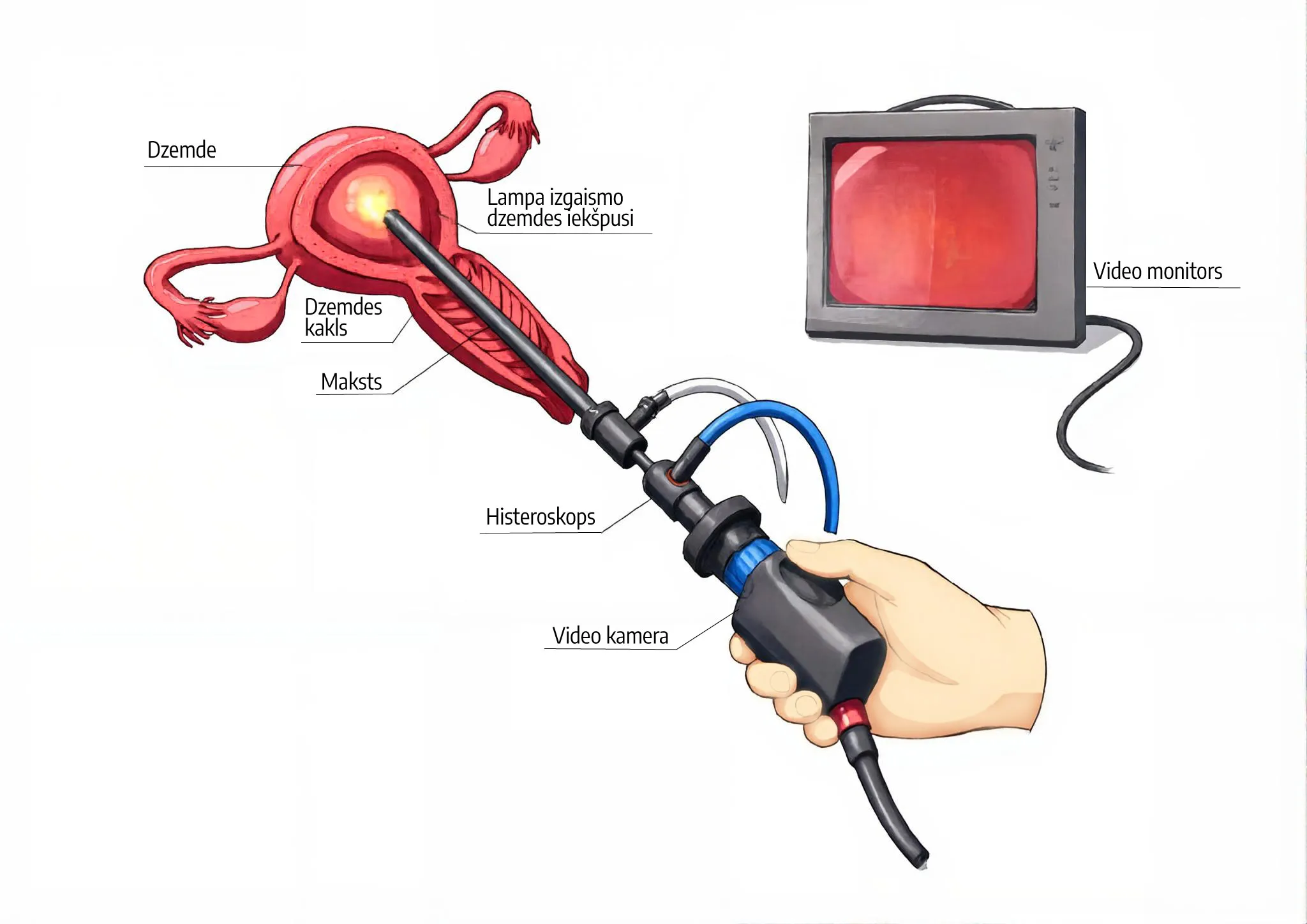 Ofisa histeroskopija - ilustratīvs attēls
